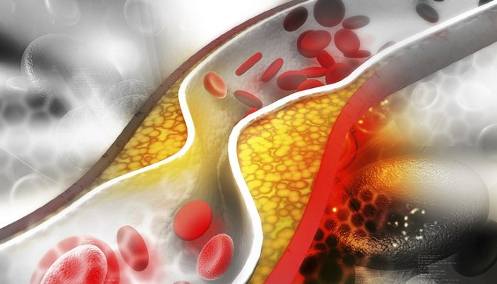 Kolesterol yang tinggi dalam darah adalah berisiko besar untuk mengalami penyakit jantung. BioVCO