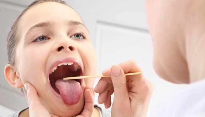 Tonsil bengkak dalam istilah perubatan dipanggil sebagai tonsilitis. Ia juga merujuk kepada keradangan tonsil. BioVCO