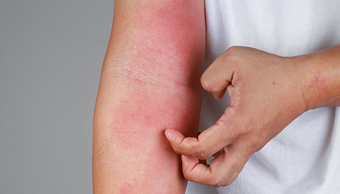 penyakit kulit Ekzema dan Psoriasis kelihatan sama, terdapat beberapa ciri antara psoriasis dan ekzema BioVCO