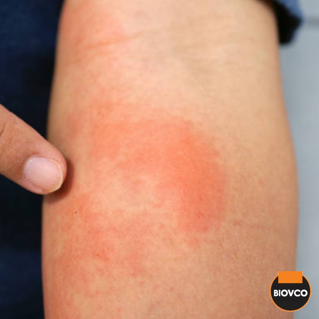 Psoriasis adalah gangguan kulit yang boleh disebabkan oleh pelbagai faktor